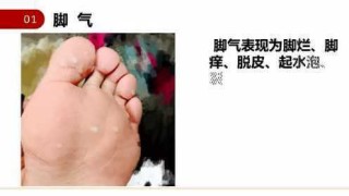 知乎：4949开奖免费大全-什么是脚气病
