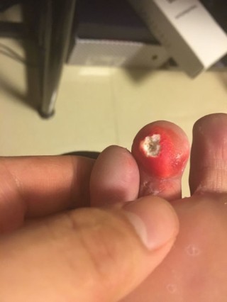 微博订阅:澳门一码一码100准确-肉刺是什么