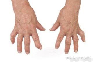 搜狐:2024年新澳门王中王资料-类风湿什么症状