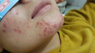微博:澳门免费公开资料大全-长痘痘涂什么药膏