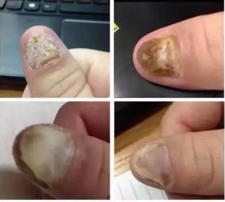 搜狐:今晚澳门开准确生肖12月4日-为什么会得灰指甲