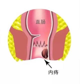 抖音视频:2024澳门新资料大全免费直播-痔疮吃什么药好得快