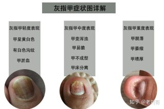 微博订阅:澳门平特一肖100%免费-灰指甲不治疗有什么后果