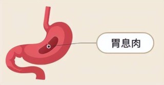 火山视频:2024年澳门正版资料大全免费-乙状结肠腺瘤是什么病