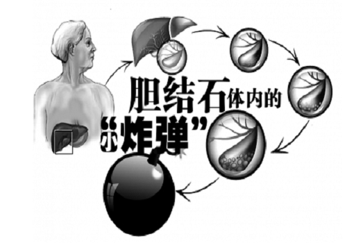 微博:澳门一码一肖100%精准-胆囊结石用什么药好  第1张