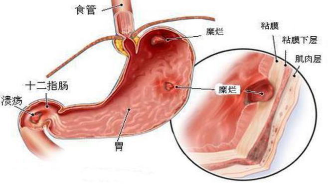 腾讯：2024澳门开奖结果查询-十二指肠球部溃疡a1期是什么意思  第3张