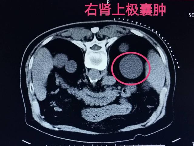抖音视频:澳门一肖一码必中一肖-肾囊肿是什么原因引起的  第3张
