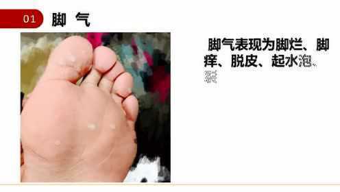 知乎：4949开奖免费大全-什么是脚气病  第2张