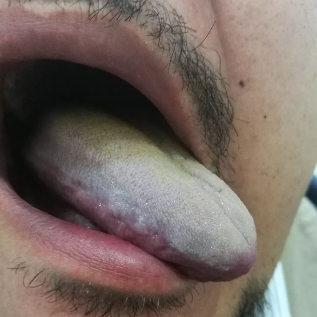 微博订阅:二四六王中王香港资料-舌苔厚腻发白是什么原因  第2张
