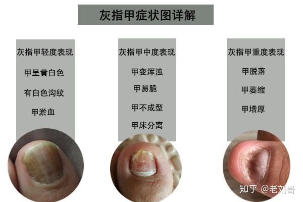 微博订阅:澳门平特一肖100%免费-灰指甲不治疗有什么后果  第2张