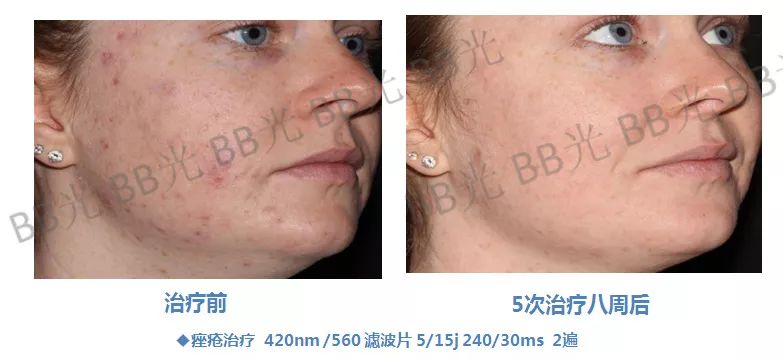 腾讯：2004新澳精准资料免费提供-左脸长痘痘是什么原因  第3张