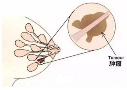 百度平台:新澳彩资料免费资料大全-乳腺囊肿和乳腺结节有什么区别  第1张