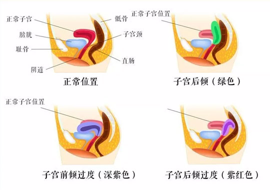 知乎：香港4777777最快开码-子宫后倾位是什么意思  第1张