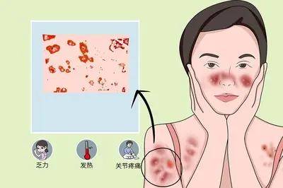 抖音视频:澳门正版资料大全免费六肖-红斑狼疮的症状是什么  第2张