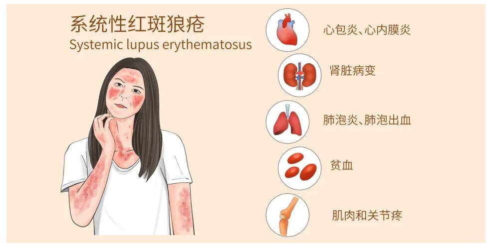 抖音视频:澳门正版资料大全免费六肖-红斑狼疮的症状是什么  第3张